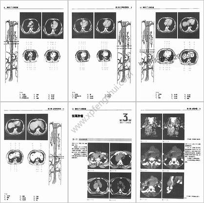 胸部CT诊断图谱